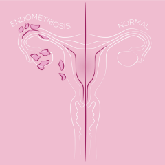 ForEndometriosis_common_accent240x240